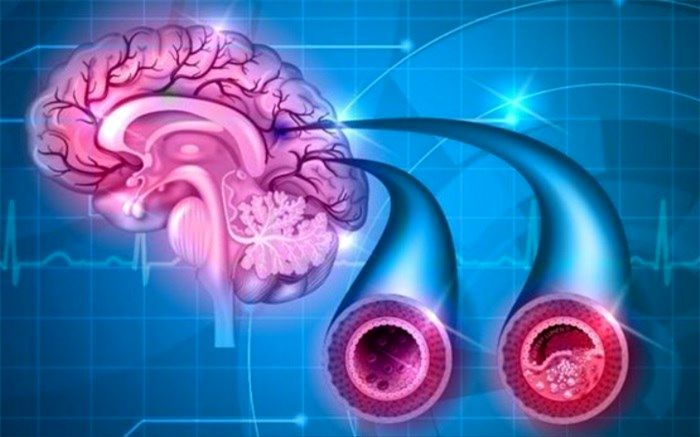 درمان زوال عقل با داروی فشار خون
