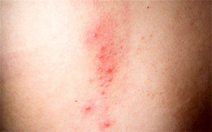 خارش پوست سینه؛ از دلایل تا درمان