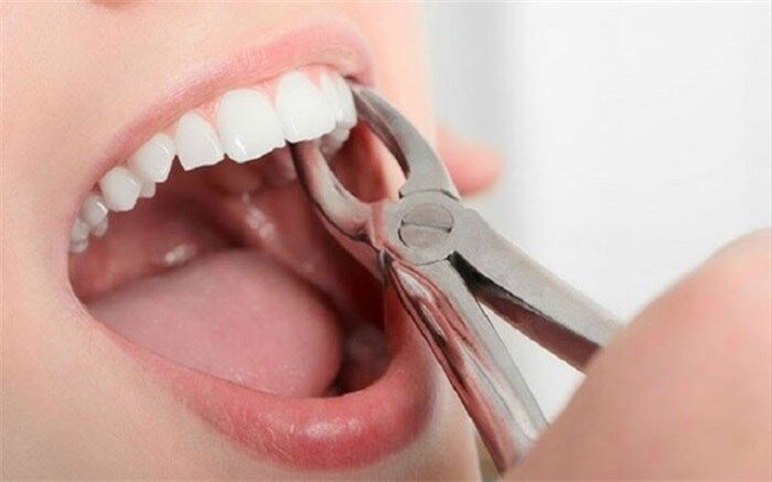 کشیدن دندان از نتایج بالا رفتن تعرفه‌های دندانپزشکی در خراسان شمالی