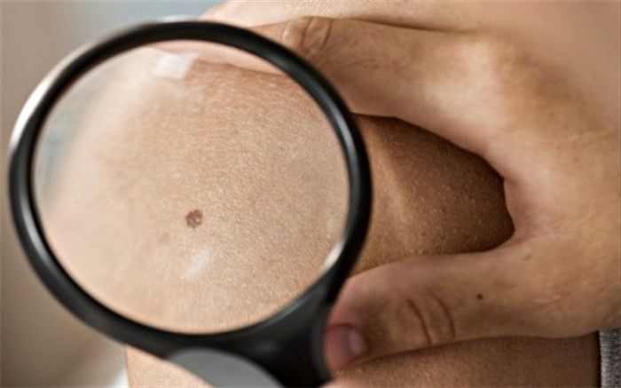 10 نشانه خال سرطانی!