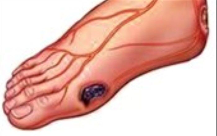 از پای دیابتیک چه می‌دانید؟