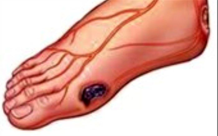 از پای دیابتیک چه می‌دانید؟