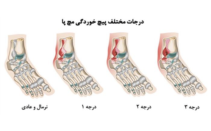 پس از پیچ خوردن مچ‌پا چه باید کرد