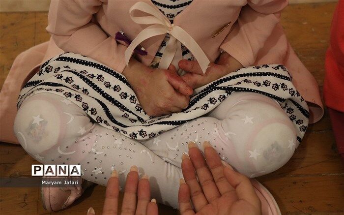 مرگ ۱۵ کودک ای‌بی به علت تحریم پانسمان میپلکس