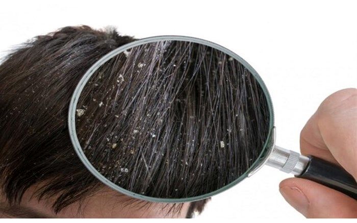 شوره؛ وقتی که پوست سر خشک نیست!