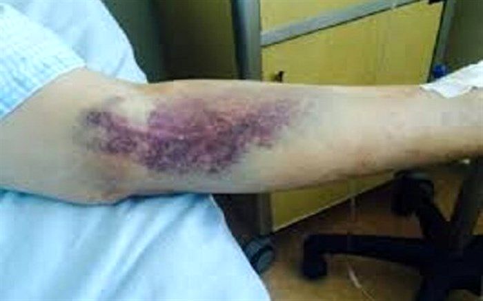 خبر فوت بر اثر ابتلا به CCHF در خراسان‌شمالی تکذیب شد