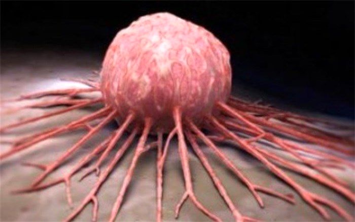 زنان ایرانی از تازه‌ترین روش‌های مواجهه با سرطان پستان چه می‌دانند