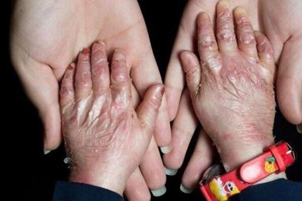بیماران نادر؛ قربانیان وعده‌های تکراری و صندوقی که هنوز شفاف نیست